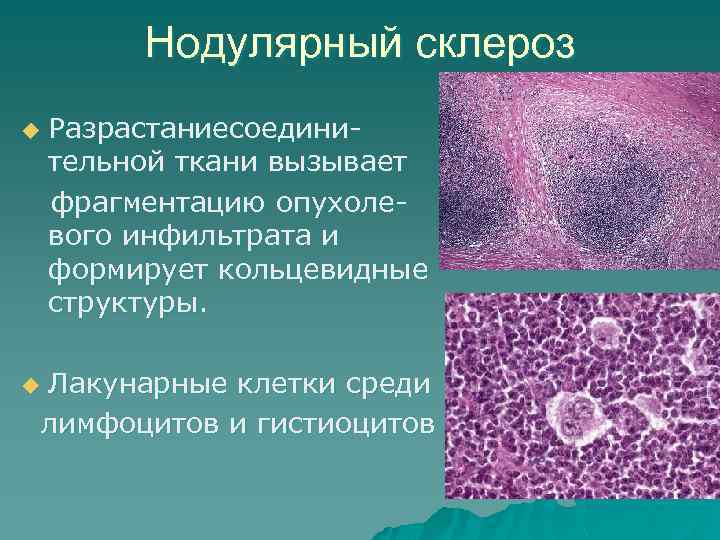 Нодулярный склероз u Разрастаниесоединительной ткани вызывает фрагментацию опухолевого инфильтрата и формирует кольцевидные структуры Лакунарные