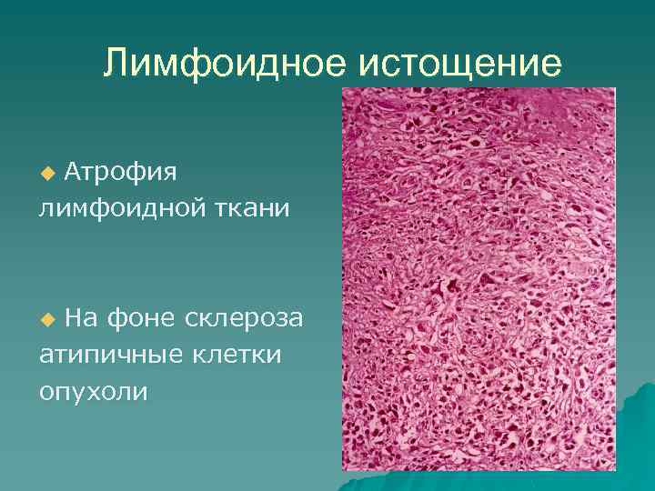 Лимфоидное истощение Атрофия лимфоидной ткани u На фоне склероза атипичные клетки опухоли u 