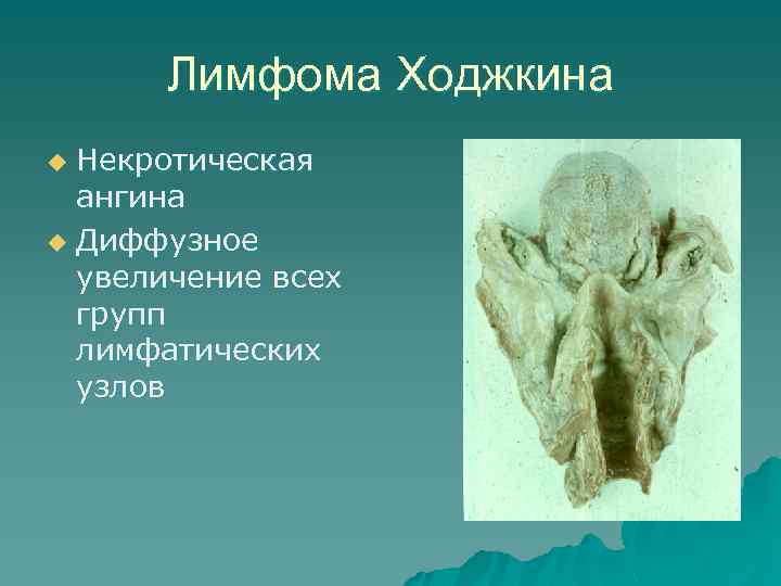 Лимфома Ходжкина Некротическая ангина u Диффузное увеличение всех групп лимфатических узлов u 