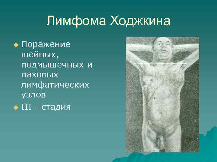 Лимфома Ходжкина Поражение шейных, подмышечных и паховых лимфатических узлов u III - стадия u
