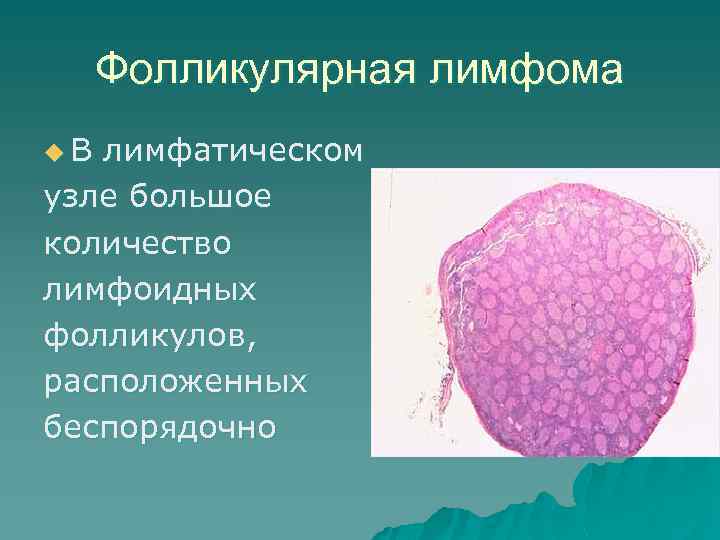 Фолликулярная лимфома u. В лимфатическом узле большое количество лимфоидных фолликулов, расположенных беспорядочно 