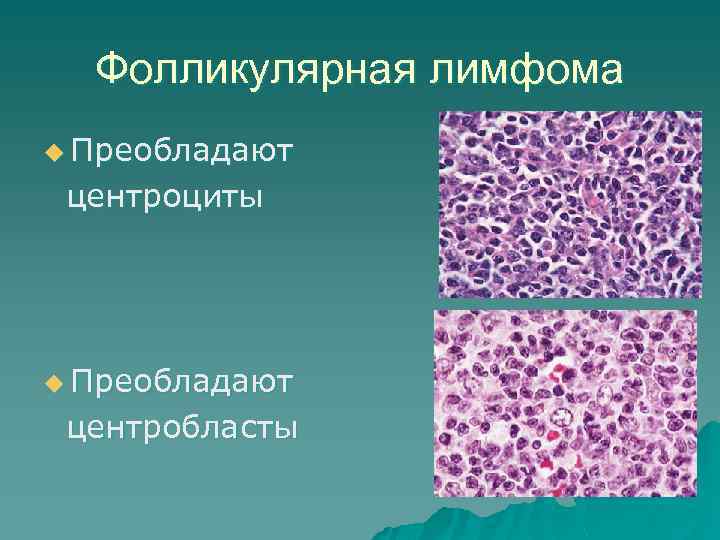 Фолликулярная лимфома u Преобладают центроциты u Преобладают центробласты 