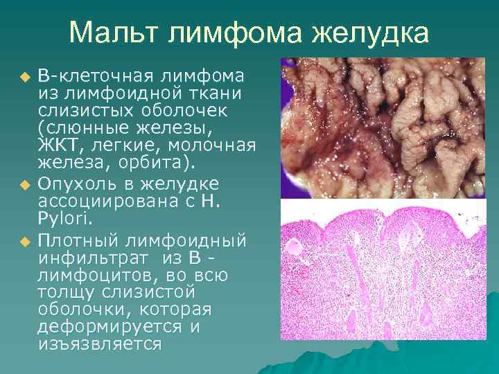 Мальт лимфома желудка u u u В-клеточная лимфома из лимфоидной ткани слизистых оболочек (слюнные