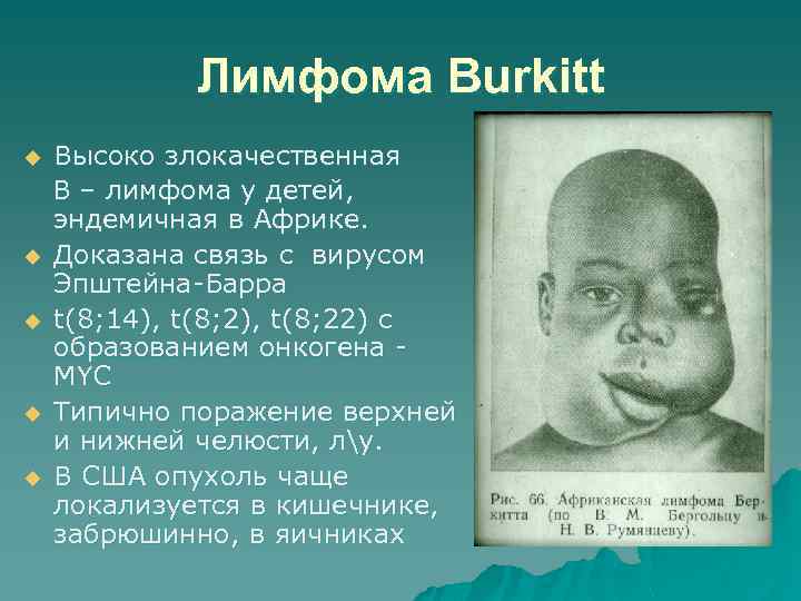 Лимфома Burkitt u u u Высоко злокачественная В – лимфома у детей, эндемичная в