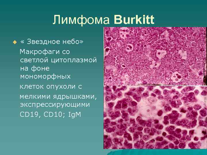 Лимфома Burkitt u « Звездное небо» Макрофаги со светлой цитоплазмой на фоне мономорфных клеток