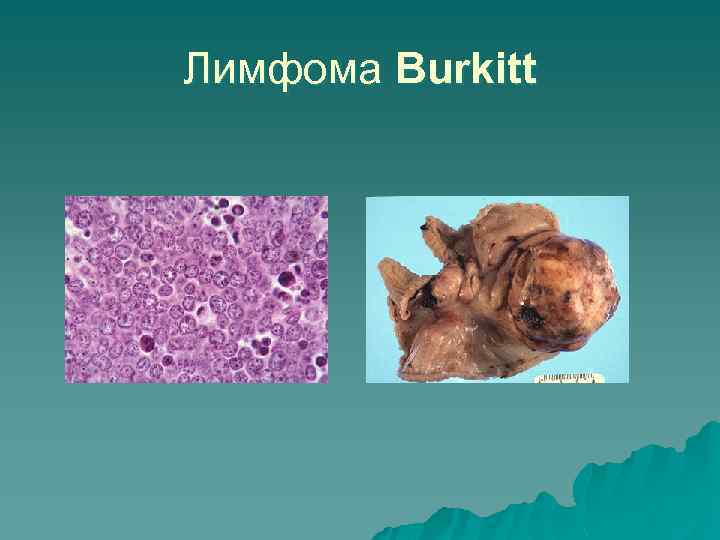Лимфома Burkitt 