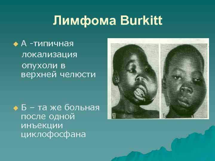 Лимфома Burkitt u u А -типичная локализация опухоли в верхней челюсти Б – та