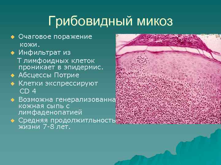 Грибовидный микоз u u u Очаговое поражение кожи. Инфильтрат из Т лимфоидных клеток проникает