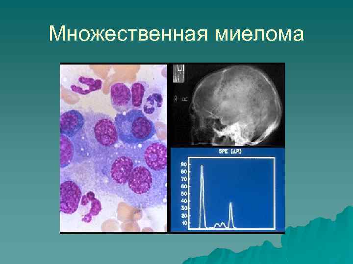 Множественная миелома 
