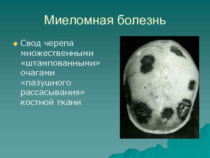 Миеломная болезнь u Свод черепа множественными «штампованными» очагами «пазушного рассасывания» костной ткани 