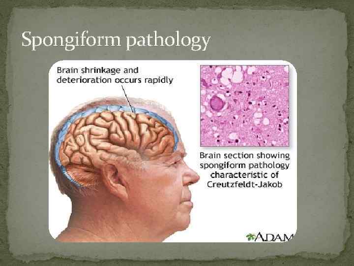 Spongiform pathology 