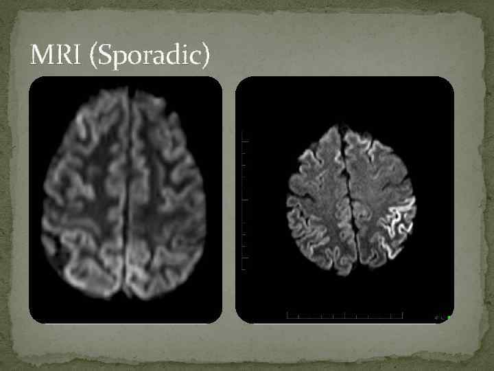 MRI (Sporadic) 