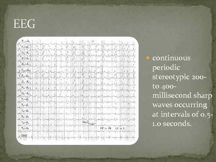 EEG continuous periodic stereotypic 200 - to 400 millisecond sharp waves occurring at intervals