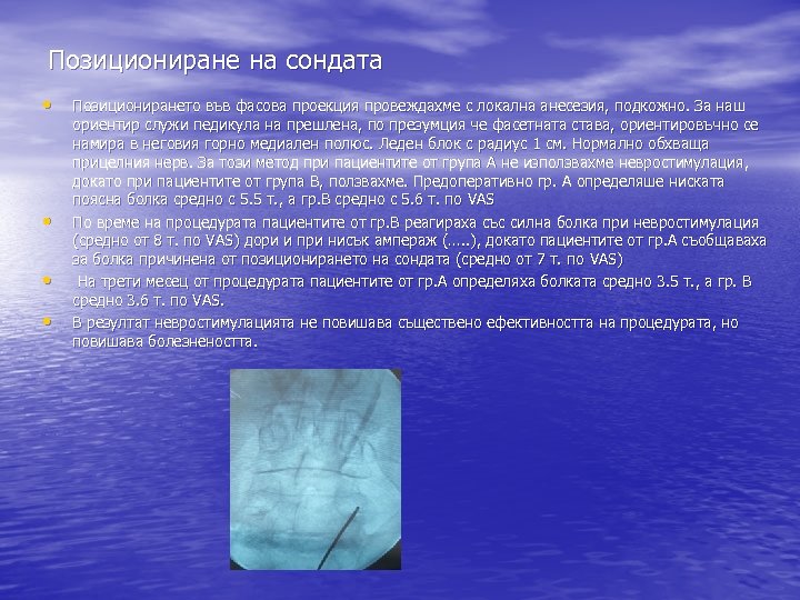 Позициониране на сондата • • Позиционирането във фасова проекция провеждахме с локална анесезия, подкожно.