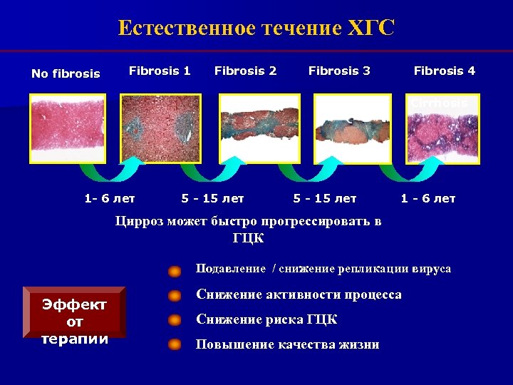 Естественное течение ХГС No fibrosis Fibrosis 1 Fibrosis 2 Fibrosis 3 Fibrosis 4 Cirrhosis