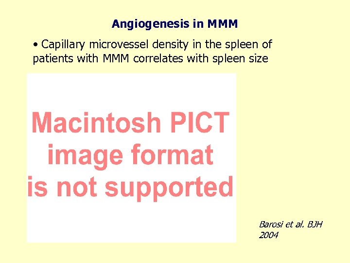 Angiogenesis in MMM • Capillary microvessel density in the spleen of patients with MMM