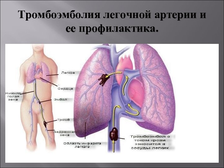 Тромбоэмболия легочной артерии и ее профилактика. 