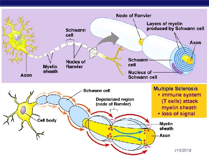 Multiple Sclerosis § immune system (T cells) attack myelin sheath § loss of signal