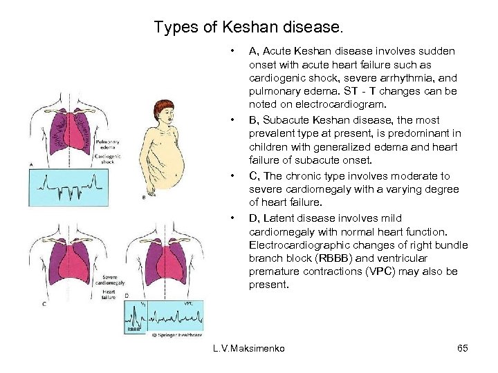 Types of Keshan disease. • • A, Acute Keshan disease involves sudden onset with