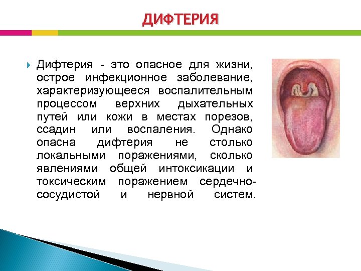 ДИФТЕРИЯ Дифтерия - это опасное для жизни, острое инфекционное заболевание, характеризующееся воспалительным процессом верхних