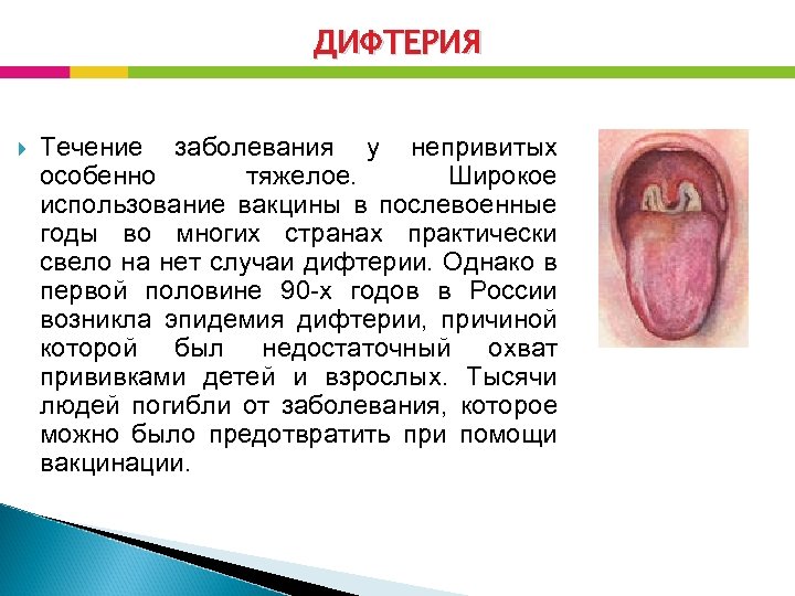 ДИФТЕРИЯ Течение заболевания у непривитых особенно тяжелое. Широкое использование вакцины в послевоенные годы во
