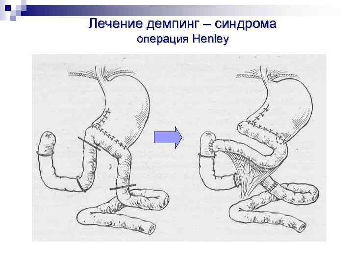 Демпинг синдром патофизиология презентация