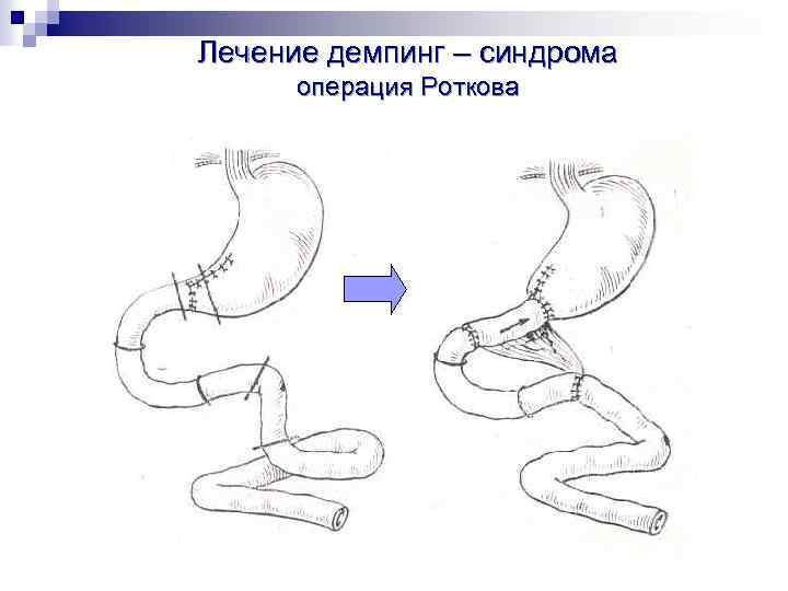 Демпинг синдром патофизиология презентация