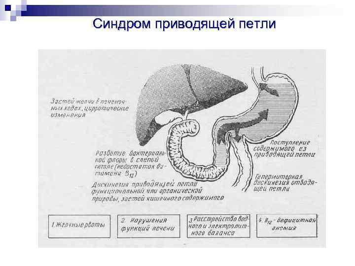 Синдром приводящей петли 