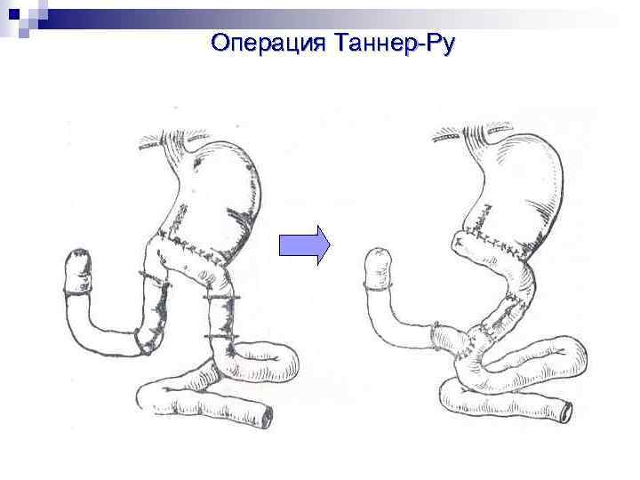 Анастомоз по ру схема