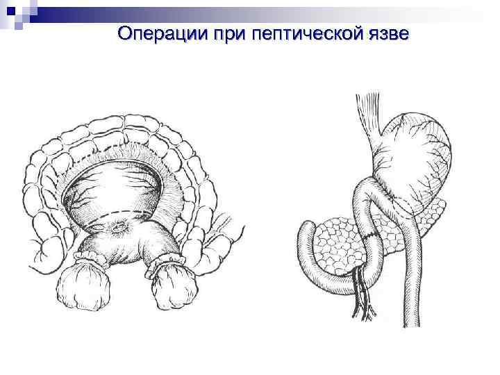 Каши атония кишечника