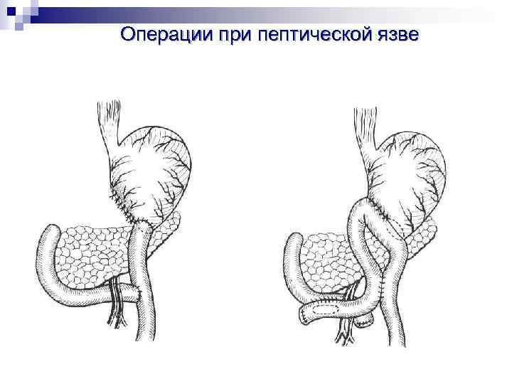 Анастомоз по брауну схема