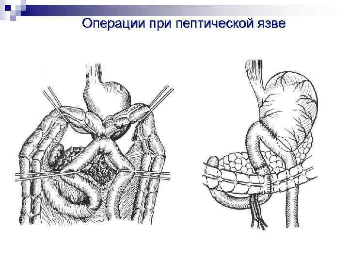 Операции при пептической язве 