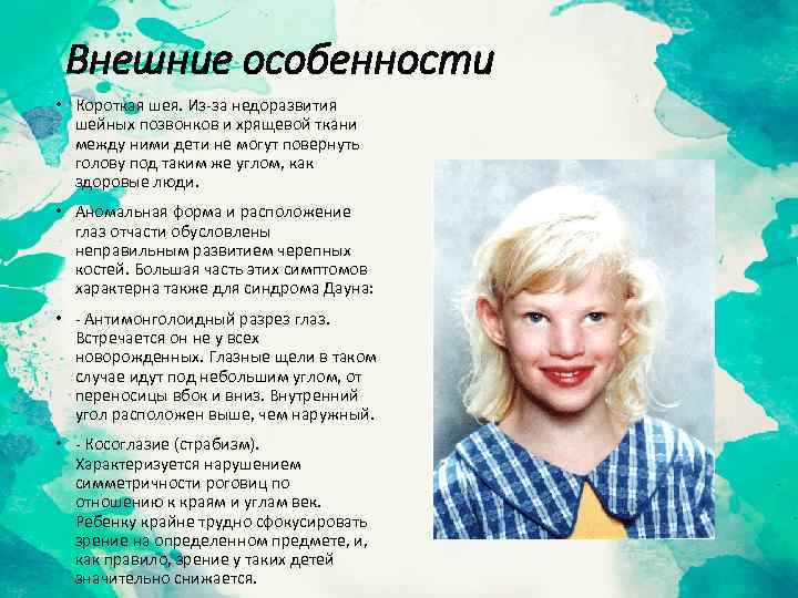 Внешние особенности • Короткая шея. Из-за недоразвития шейных позвонков и хрящевой ткани между ними