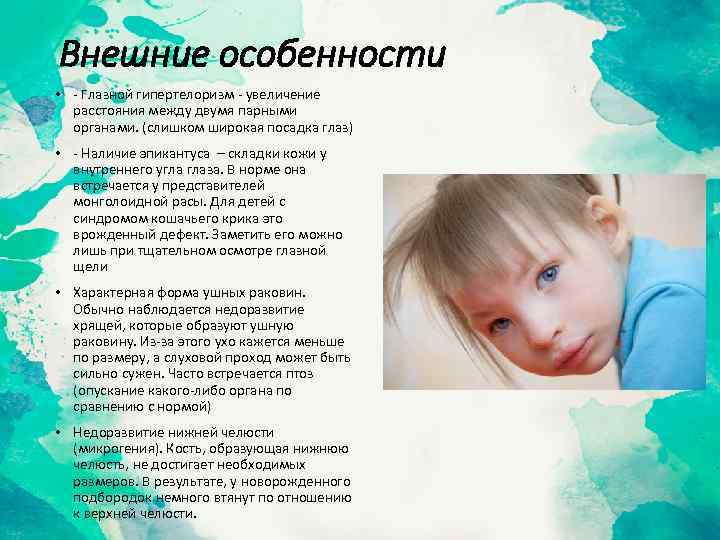 Внешние особенности • - Глазной гипертелоризм - увеличение расстояния между двумя парными органами. (слишком