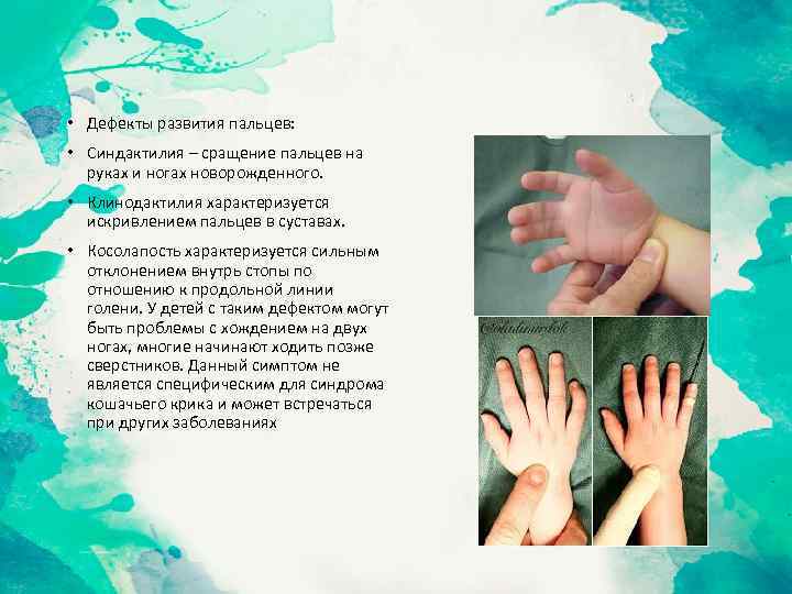  • Дефекты развития пальцев: • Синдактилия – сращение пальцев на руках и ногах