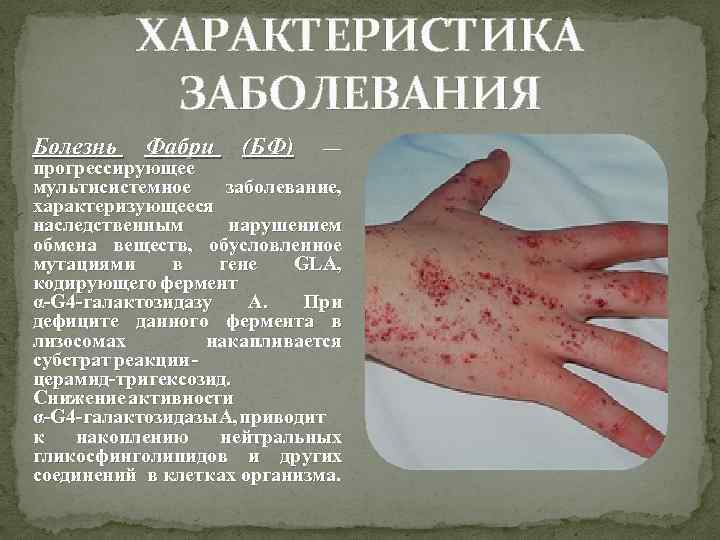 ХАРАКТЕРИСТИКА ЗАБОЛЕВАНИЯ Болезнь Фабри (БФ) ― прогрессирующее мультисистемное заболевание, характеризующееся наследственным нарушением обмена веществ,