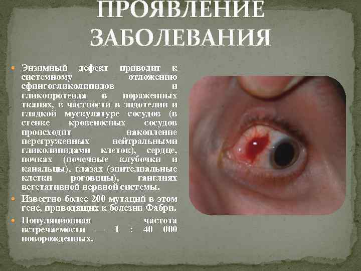 ПРОЯВЛЕНИЕ ЗАБОЛЕВАНИЯ Энзимный дефект приводит к системному отложению сфингогликолипидов и гликопротеида в пораженных тканях,