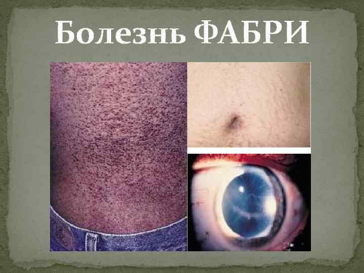 Болезнь ФАБРИ 