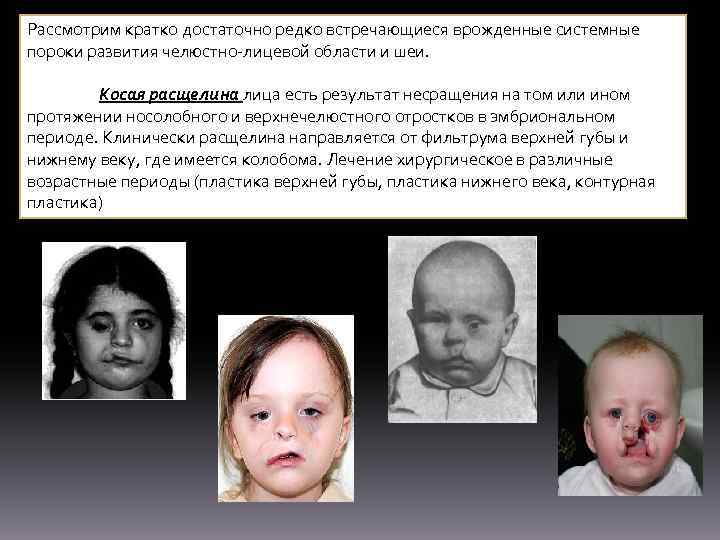 Рассмотрим кратко достаточно редко встречающиеся врожденные системные пороки развития челюстно-лицевой области и шеи. Косая