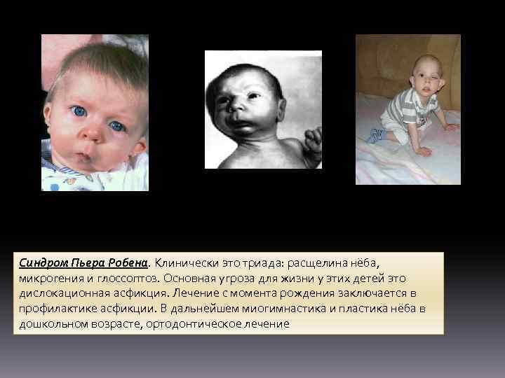 Синдром Пьера Робена. Клинически это триада: расщелина нёба, микрогения и глоссоптоз. Основная угроза для