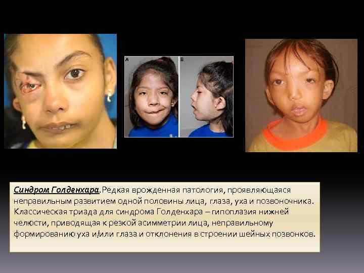 Синдром Голденхара. Редкая врожденная патология, проявляющаяся неправильным развитием одной половины лица, глаза, уха и