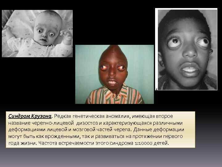 Синдром Крузона. Редкая генетическая аномалия, имеющая второе название черепно-лицевой дизостоз и характеризующаяся различными деформациями