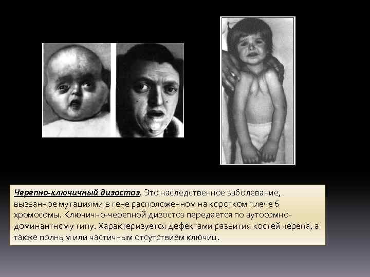 Черепно-ключичный дизостоз. Это наследственное заболевание, вызванное мутациями в гене расположенном на коротком плече 6