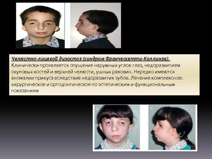Челюстно-лицевой дизостоз (синдром Франческетти-Коллинза). Клинически проявляется опущение наружных углов глаз, недоразвитием скуловых костей и