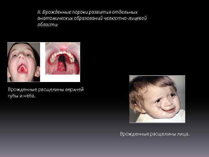 II. Врожденные пороки развития отдельных анатомических образований челюстно-лицевой области: Врожденные расщелины верхней губы и