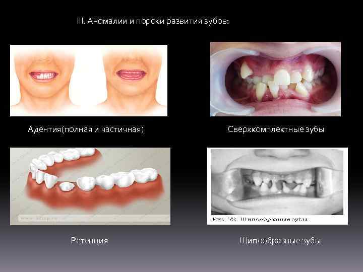 III. Аномалии и пороки развития зубов: Адентия(полная и частичная) Ретенция Сверхкомплектные зубы Шипообразные зубы