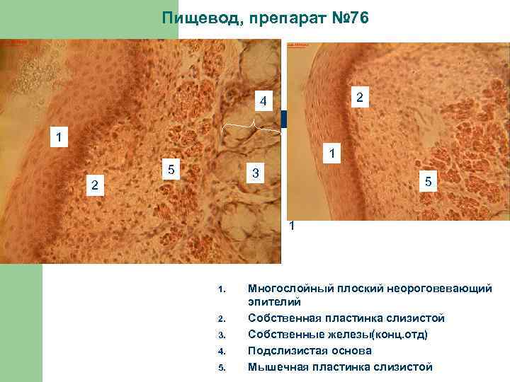 Пищевод, препарат № 76 2 4 1 1 5 3 2 5 1 1.