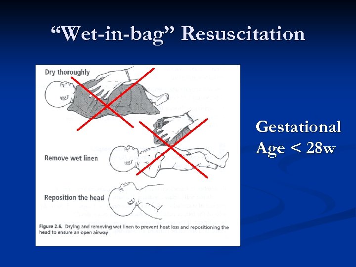 “Wet-in-bag” Resuscitation Gestational Age < 28 w 