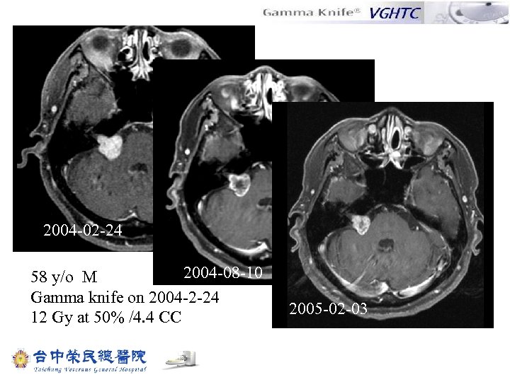 2004 -02 -24 2004 -08 -10 58 y/o M Gamma knife on 2004 -2