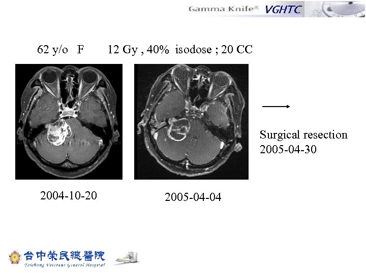 62 y/o F 12 Gy , 40% isodose ; 20 CC Surgical resection 2005